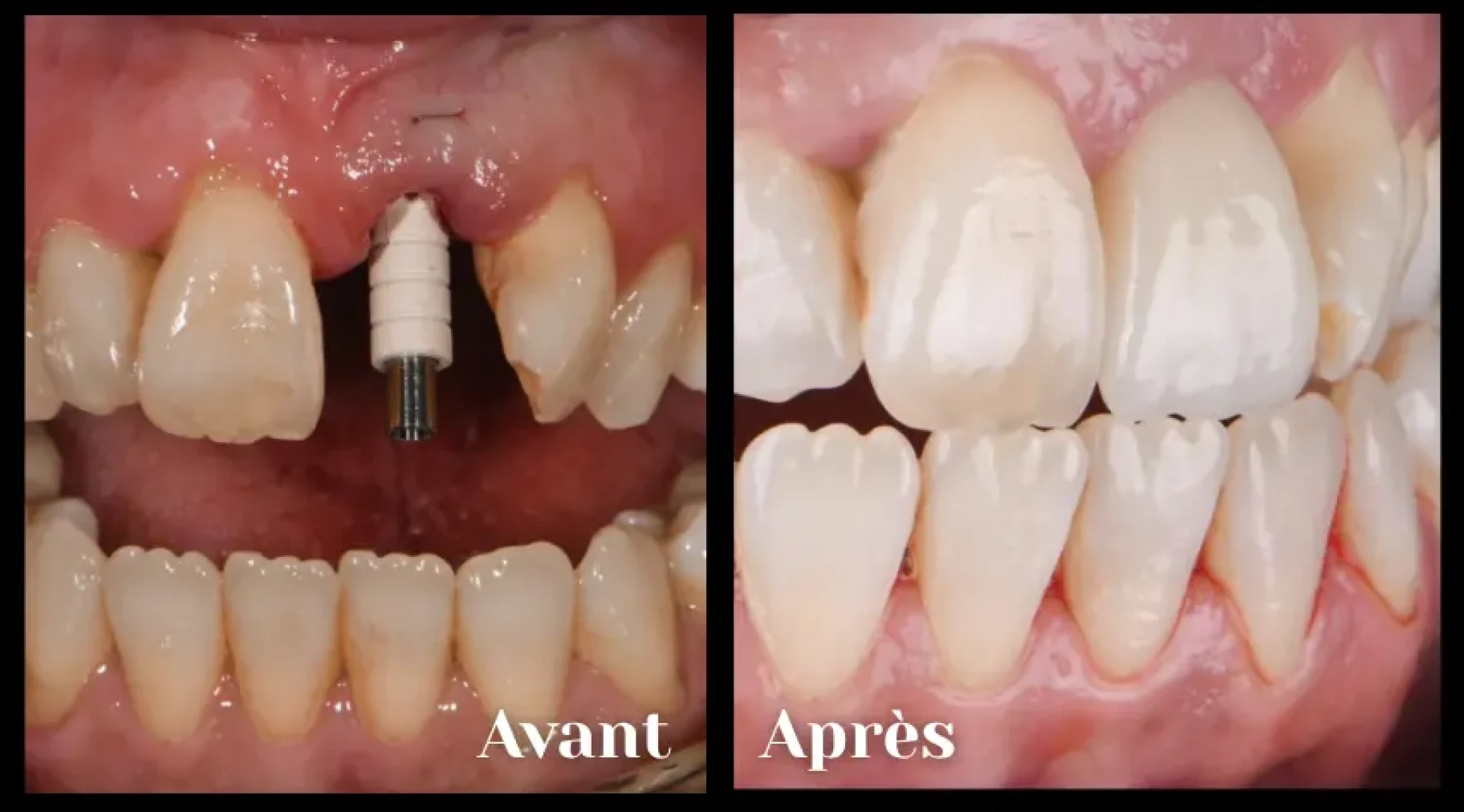 Implant dentaire à Toulouse