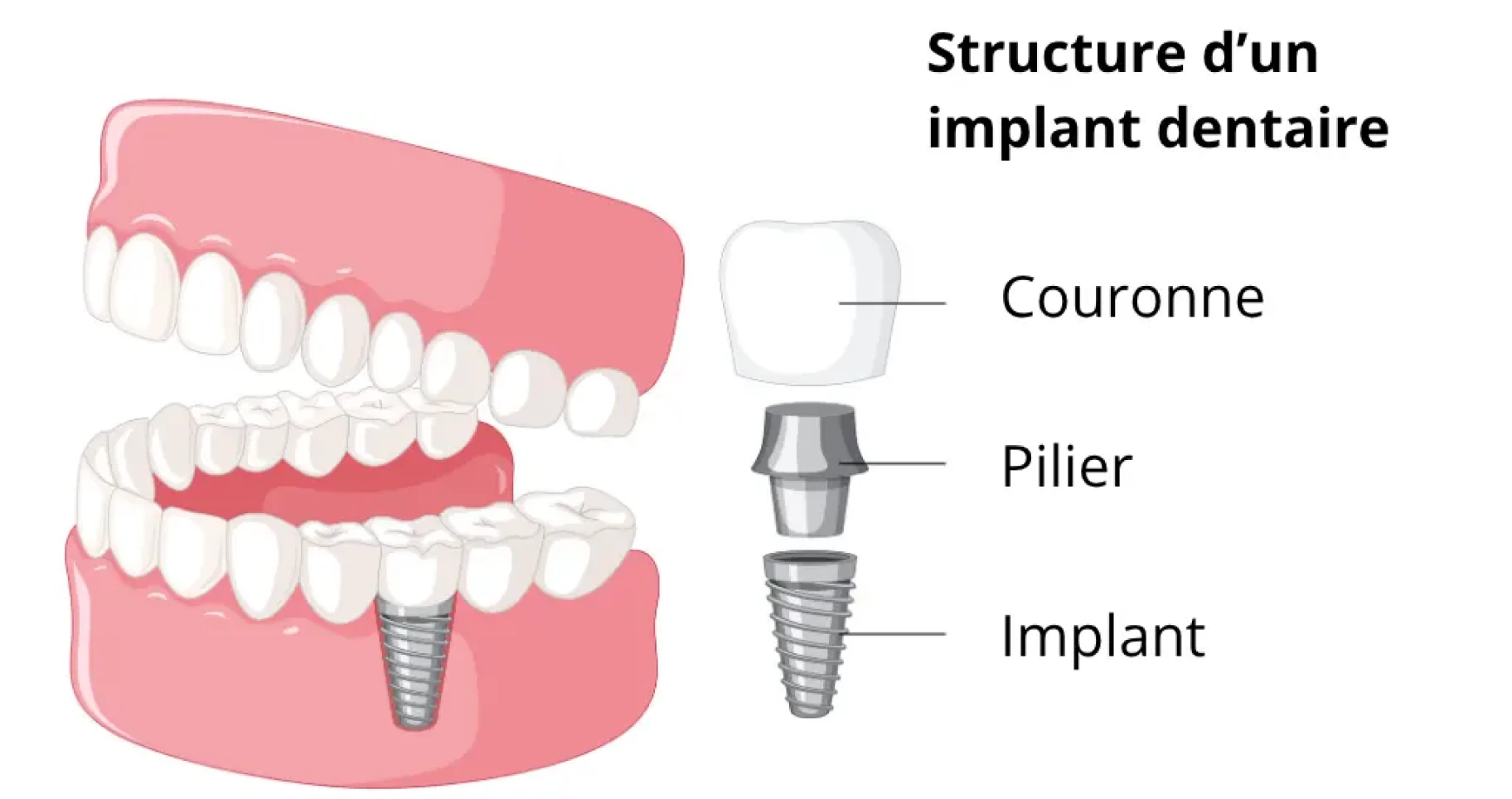 Implant dentaire à Toulouse