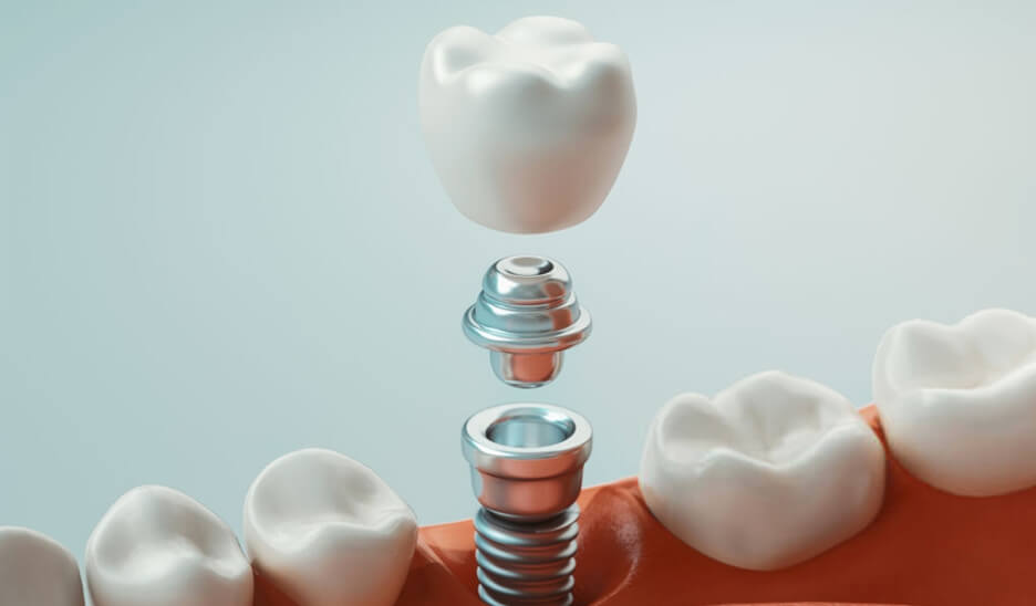 Implant dentaire implantologie Dr Benichou