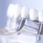 implant dentaire blog Dr Benichou Toulouse