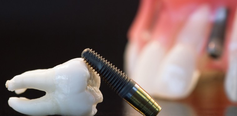 Dr Mathieu Benichou blog vie implant dentaire Toulouse