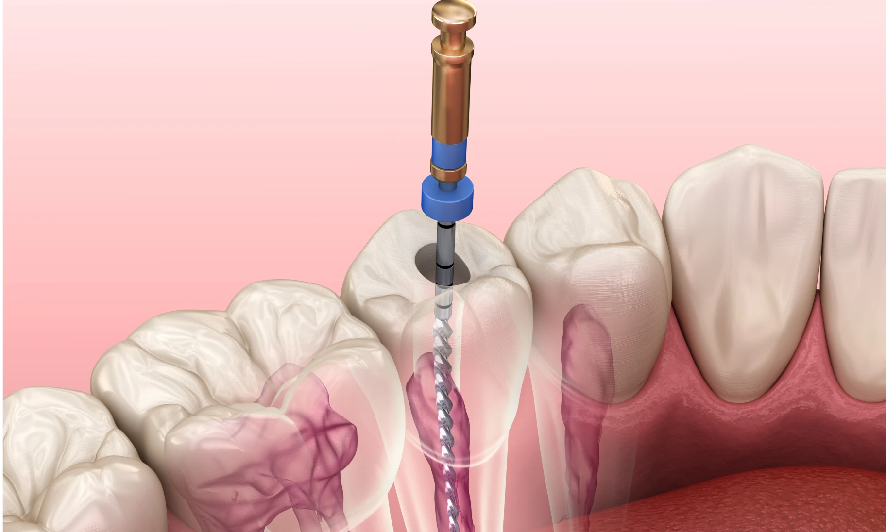 À quoi sert une apectomie dentaire ?