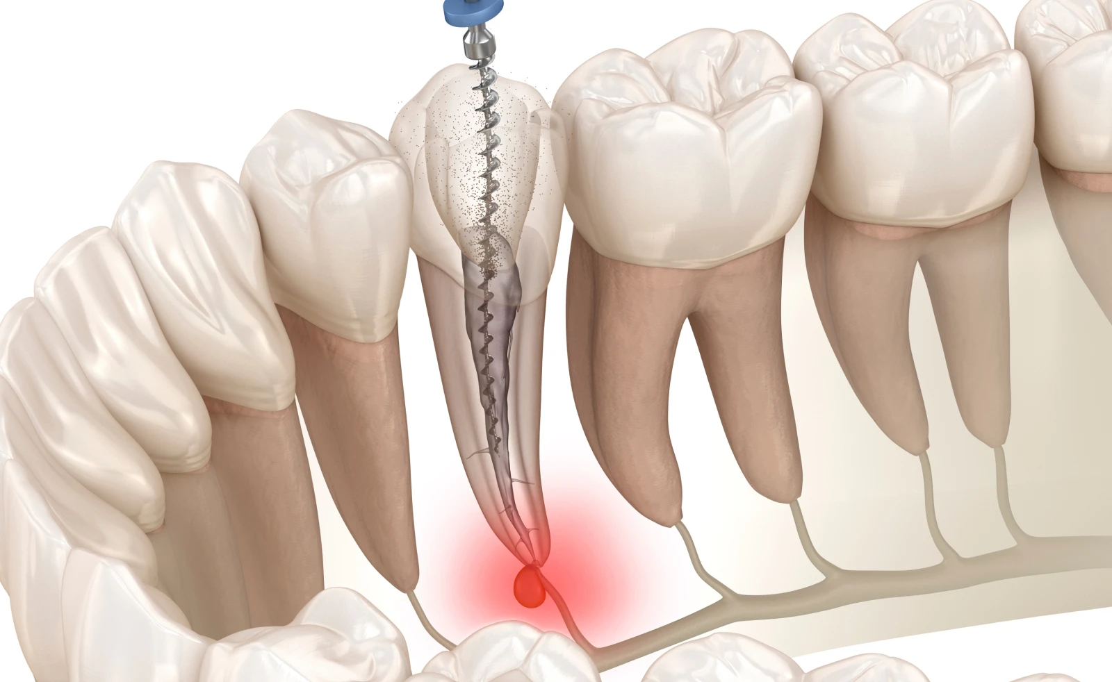 Pourquoi recourir à un traitement de canal dentaire ?