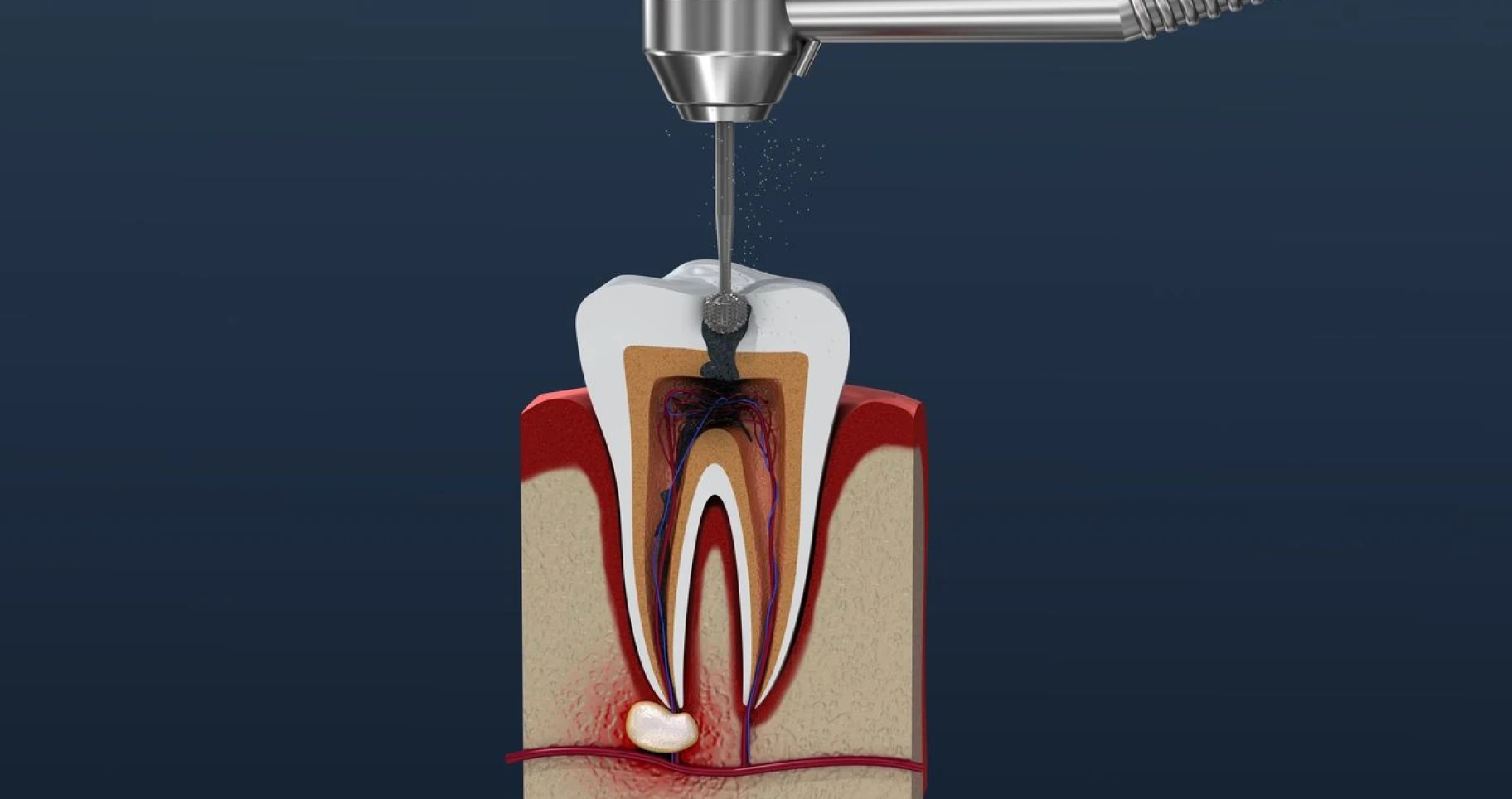 Les résections apicales en endodontie