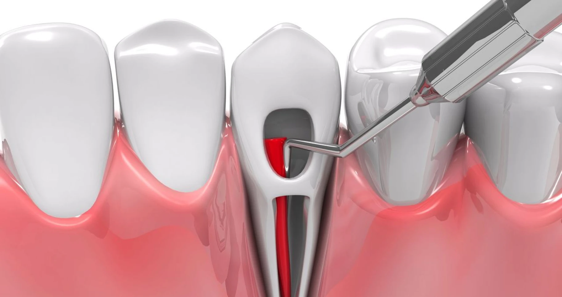 Le retraitement endodontique