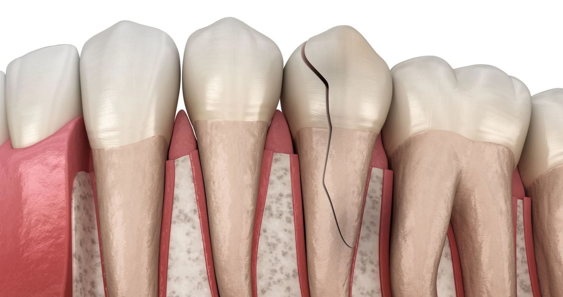 Dent fissurée : causes, symptômes et solution