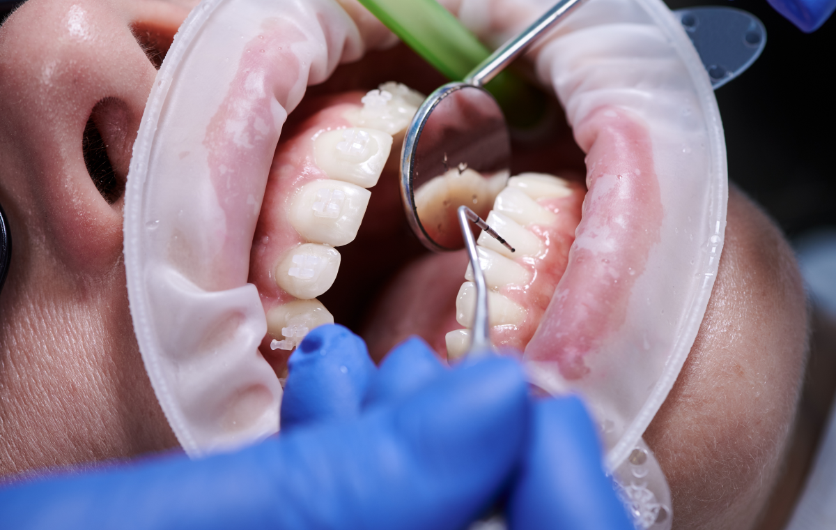 Bilan parodontal : Guide & Conseils