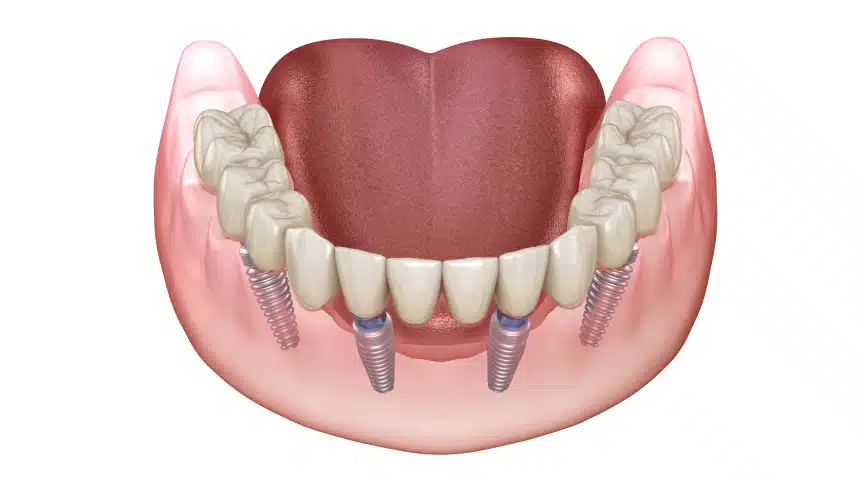 All-on-4 : la nouvelle technique d’implants Dentiste à Toulouse, Dentiste Mathieu Benichou