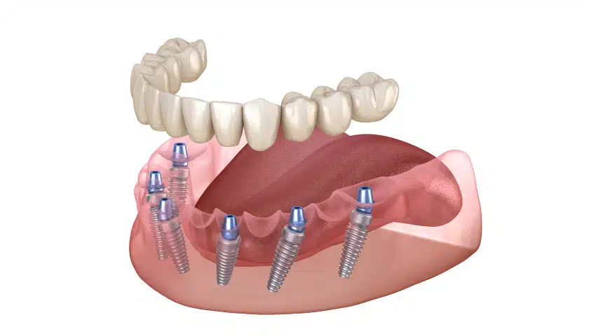 All-on-6 : la technique à 6 implants Dentiste à Toulouse, Dentiste Mathieu Benichou