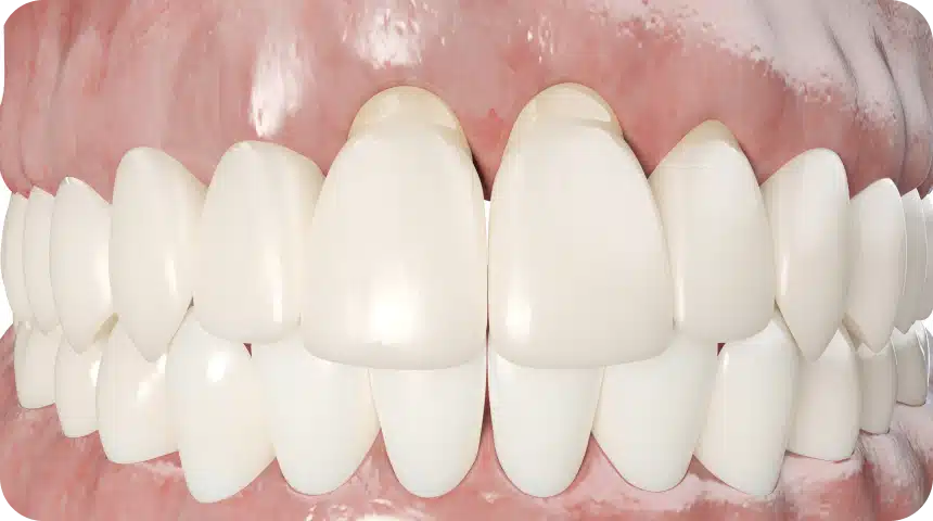 dechaussement dents dentsite toulouse Déchaussement des dents : comment l’éviter et le traiter ? Dentiste à Toulouse, Dentiste Mathieu Benichou