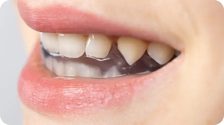 Gouttière dentaire : usages & types ! Dentiste à Toulouse, Dentiste Mathieu Benichou