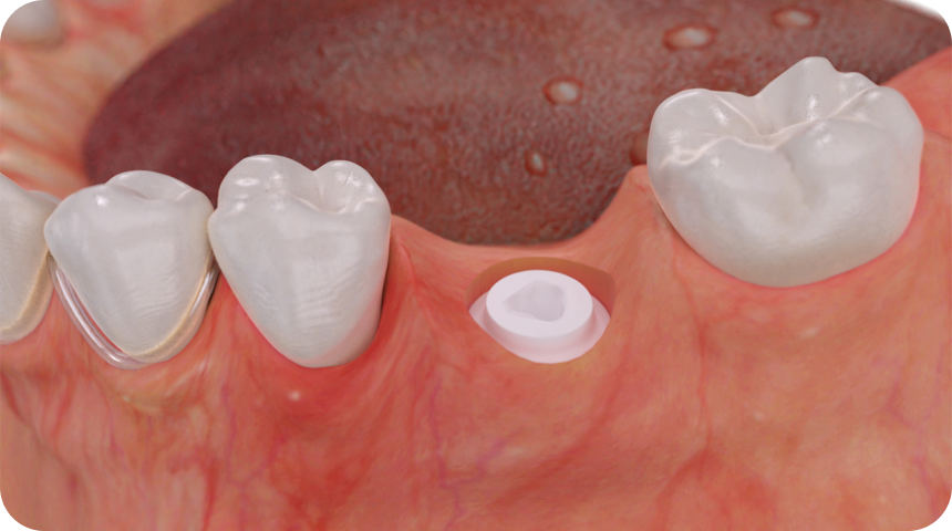 Implants céramiques en zircone Dentiste à Toulouse, Dentiste Mathieu Benichou