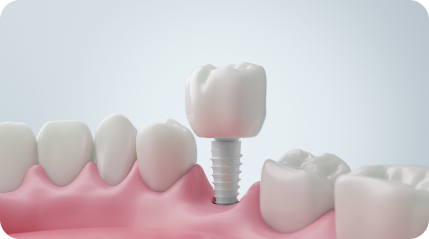 Implants céramiques en zircone Dentiste à Toulouse, Dentiste Mathieu Benichou