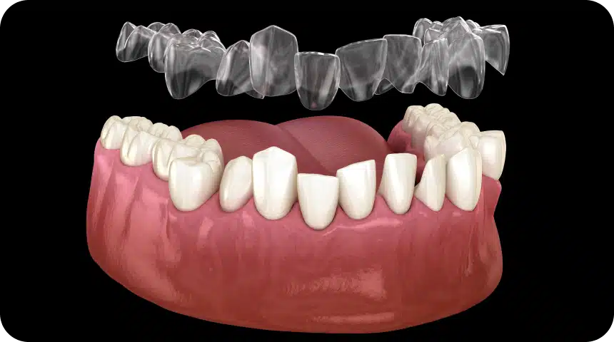 invisalign toulouse orthodontie Invisalign avant après : À quel résultat s’attendre ? Dentiste à Toulouse, Dentiste Mathieu Benichou