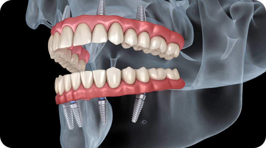 Prothèse dentaire Toulouse Dentiste à Toulouse, Dentiste Mathieu Benichou