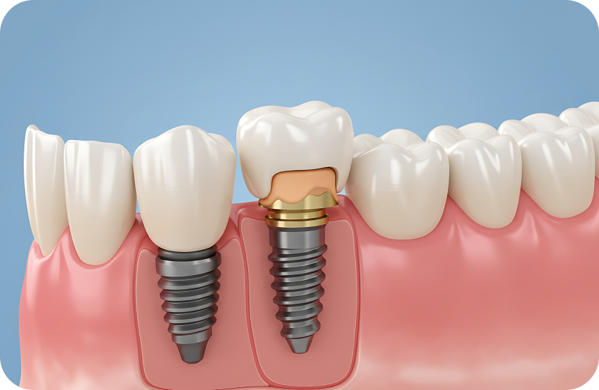 Combien d'implants dentaires peut-on poser en une fois ? Dentiste à Toulouse, Dentiste Mathieu Benichou