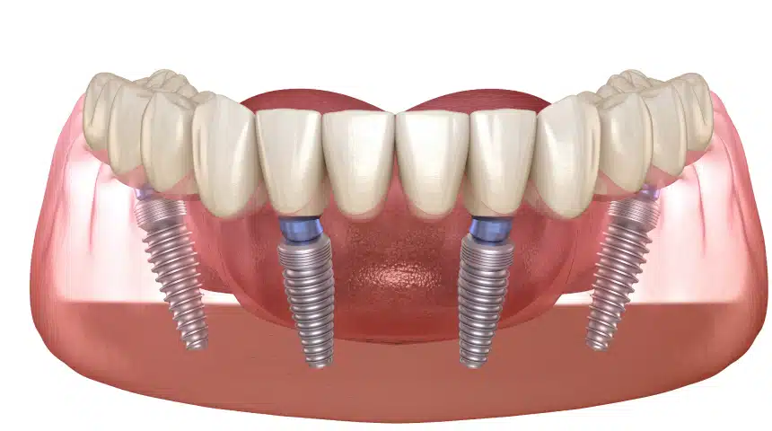 All-on-4 : la nouvelle technique d’implants Dentiste à Toulouse, Dentiste Mathieu Benichou