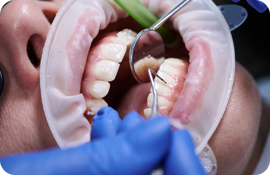 Bilan parodontal, Conseils du Dentiste à Toulouse, Dentiste Mathieu Benichou