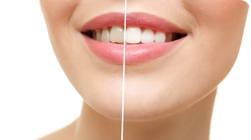 Blanchiment dentaire à Toulouse  Dentiste à Toulouse, Dentiste Mathieu Benichou