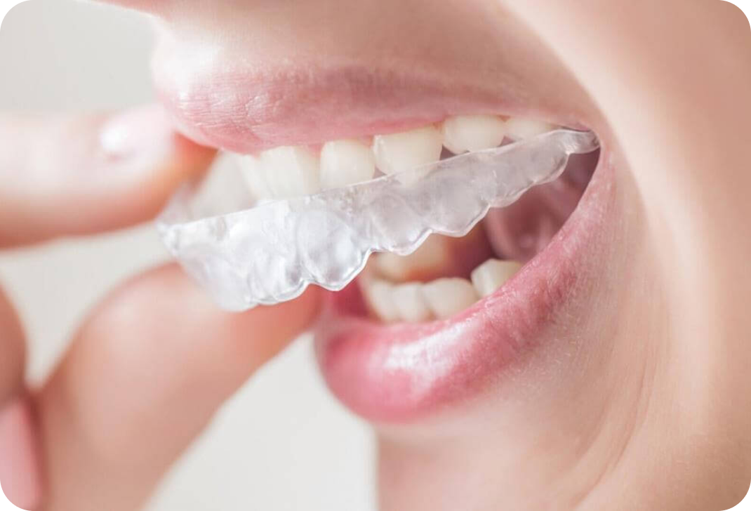 Blanchiment dentaire à Toulouse  Dentiste à Toulouse, Dentiste Mathieu Benichou