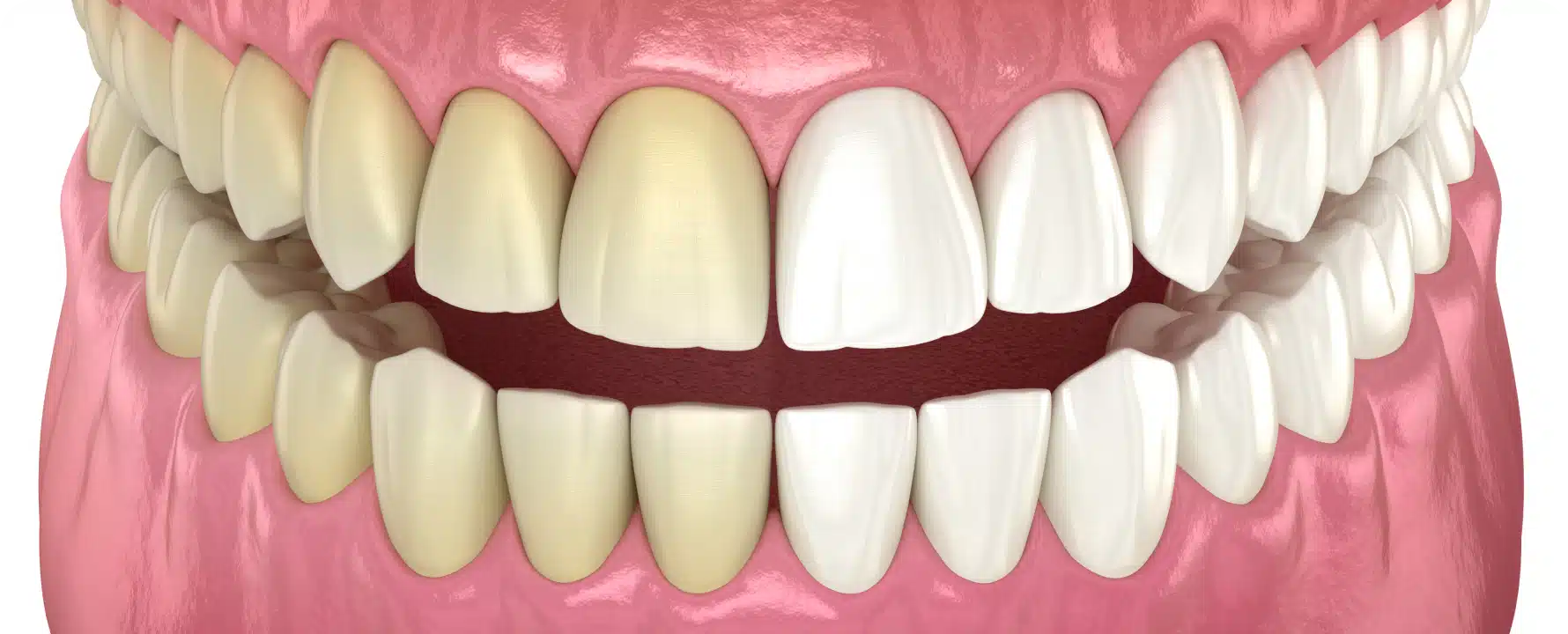 blanchir dents solutions efficaces toulouse Comment blanchir les dents ? Solutions efficaces Dentiste à Toulouse, Dentiste Mathieu Benichou