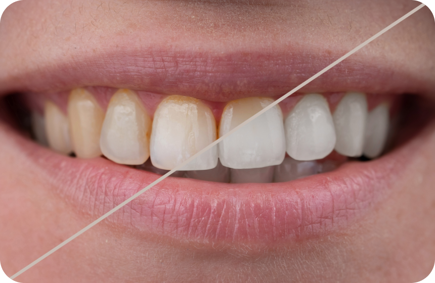 Comment blanchir les dents ? Solutions efficaces Dentiste à Toulouse, Dentiste Mathieu Benichou