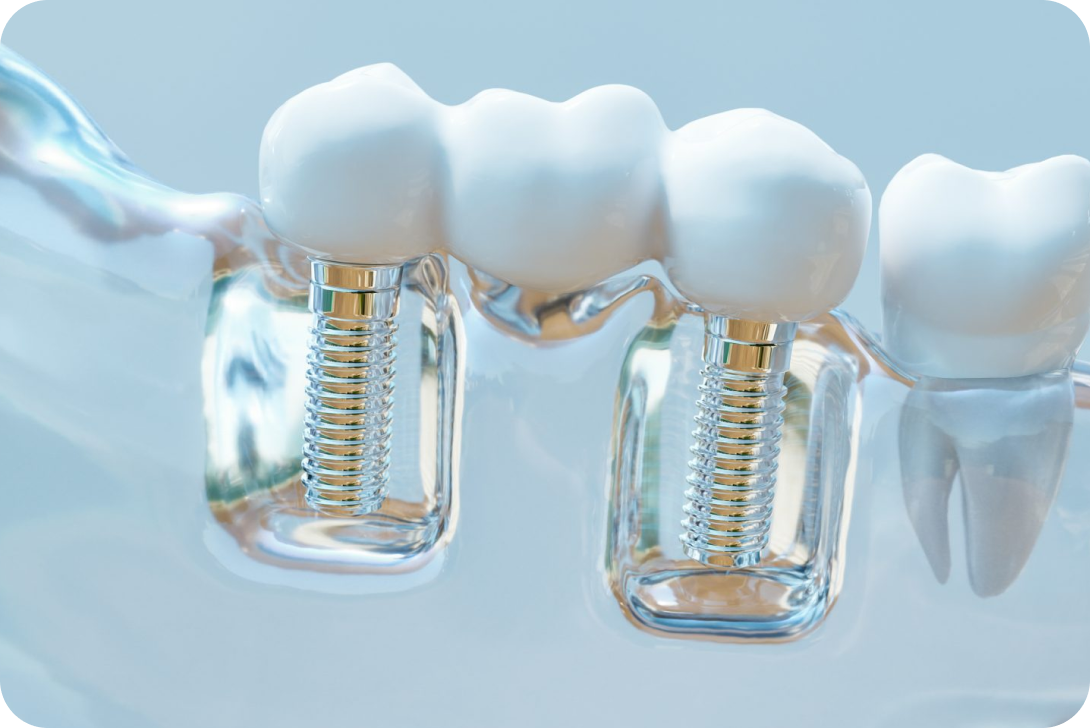 Bridge dentaire Toulouse Dentiste à Toulouse, Dentiste Mathieu Benichou