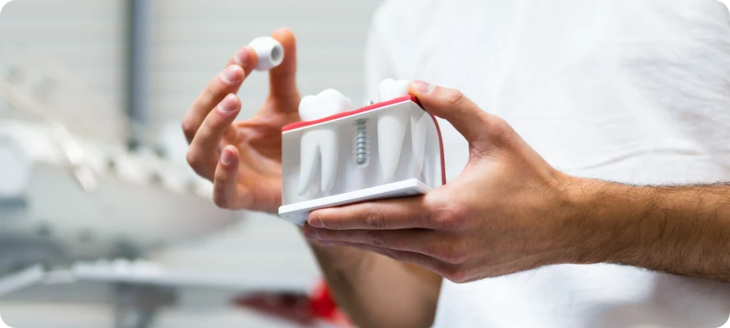 Implant dentaire à Toulouse Dentiste à Toulouse, Dentiste Mathieu Benichou