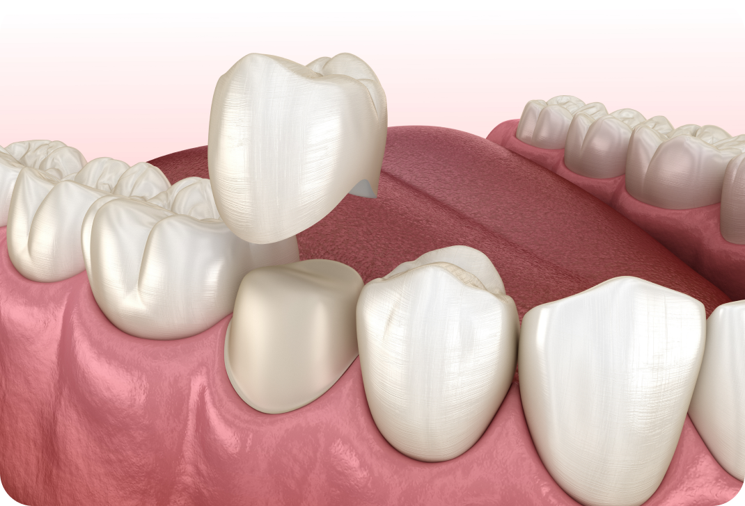 Couronne dentaire à Toulouse Dentiste à Toulouse, Dentiste Mathieu Benichou