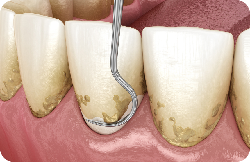 Curetage dentaire : ce qu’il faut savoir ! Dentiste à Toulouse, Dentiste Mathieu Benichou