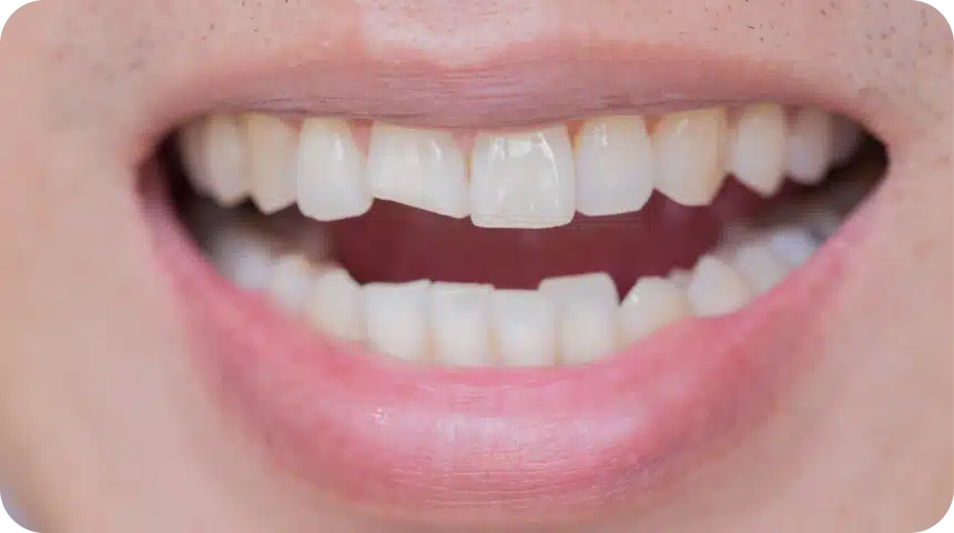 Que faire quand on a une dent fissurée ? Dentiste à Toulouse, Dentiste Mathieu Benichou
