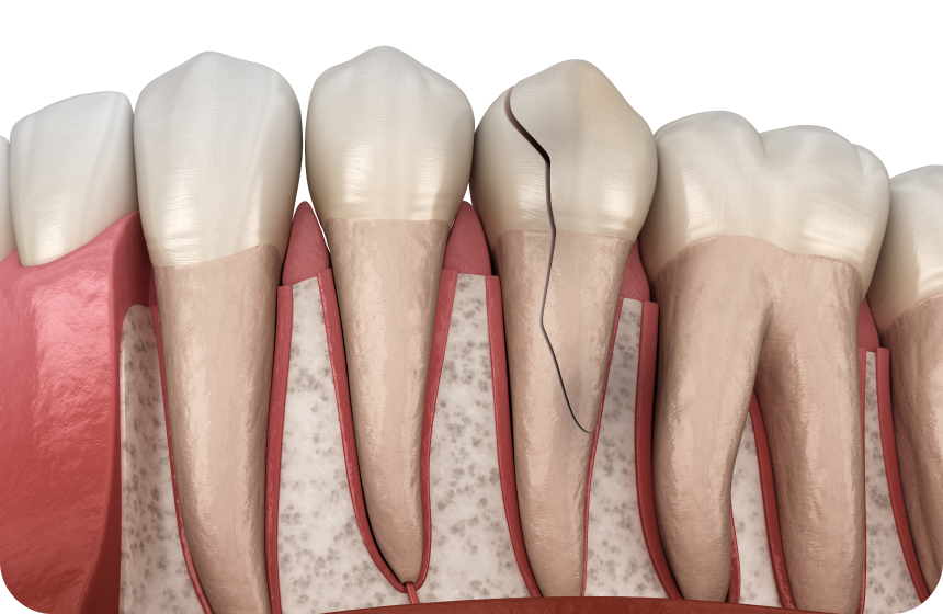 Que faire quand on a une dent fissurée ? Dentiste à Toulouse, Dentiste Mathieu Benichou