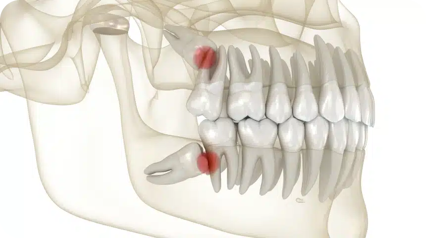 Opération dents de sagesse : on vous dit tout Dentiste à Toulouse, Dentiste Mathieu Benichou