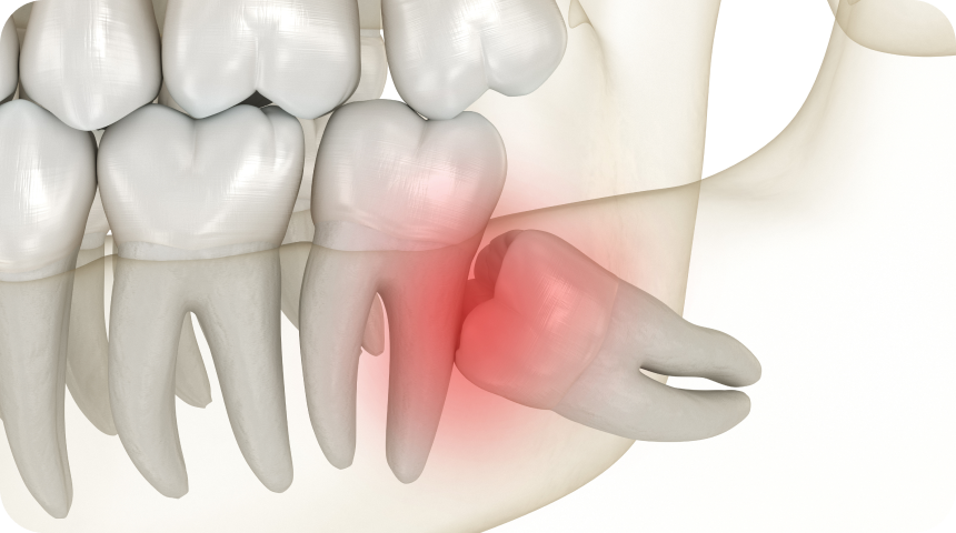 Chirurgie et dents de sagesse à Toulouse Dentiste à Toulouse, Dentiste Mathieu Benichou