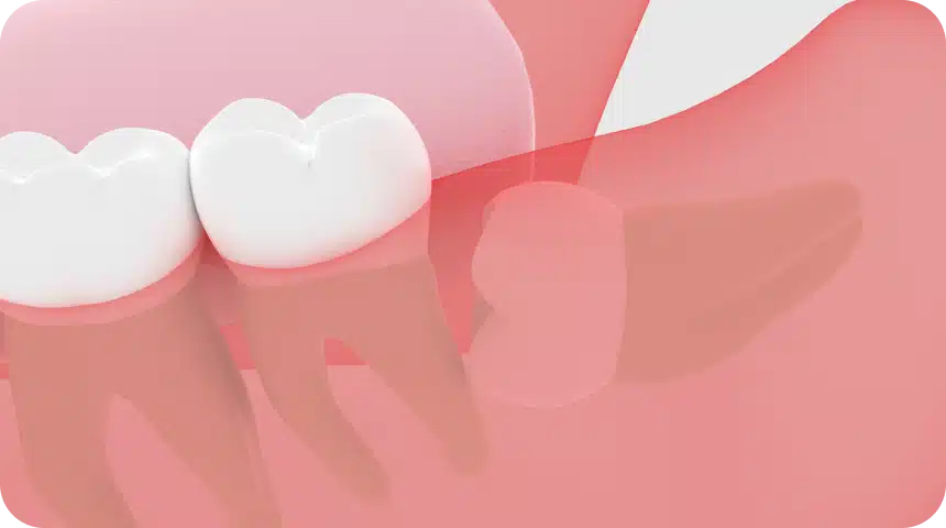 Opération dents de sagesse : on vous dit tout Dentiste à Toulouse, Dentiste Mathieu Benichou