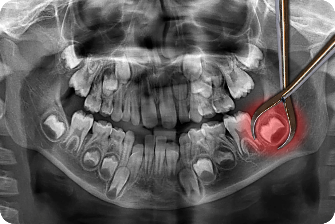 Chirurgie et dents de sagesse à Toulouse Dentiste à Toulouse, Dentiste Mathieu Benichou