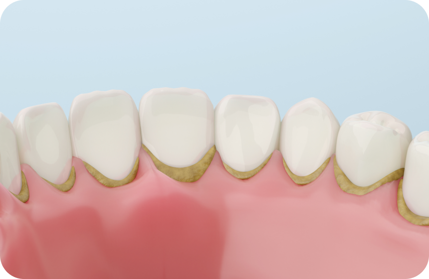 Détartrage dentaire chez le dentiste : un guide complet Dentiste à Toulouse, Dentiste Mathieu Benichou