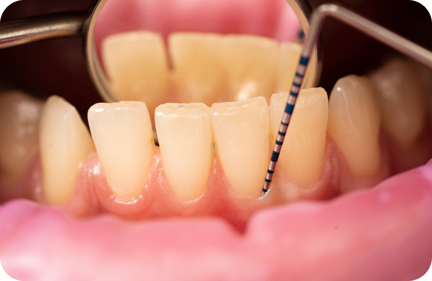 Poche gingivale : définition et traitements Dentiste à Toulouse, Dentiste Mathieu Benichou