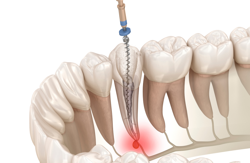 Quand et pourquoi dévitaliser une dent ? Dentiste à Toulouse, Dentiste Mathieu Benichou