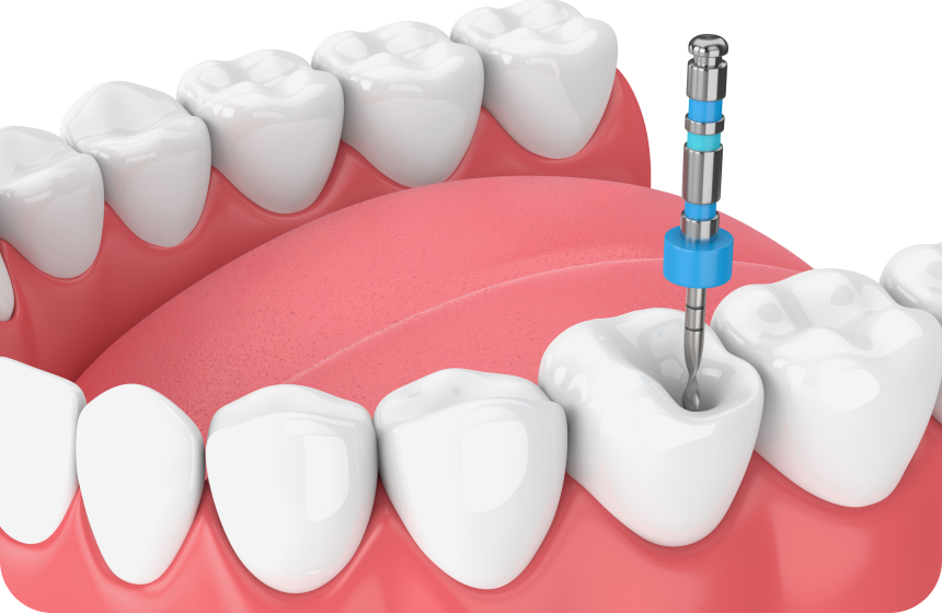 Pourquoi recourir à un traitement de canal dentaire ? Dentiste à Toulouse, Dentiste Mathieu Benichou