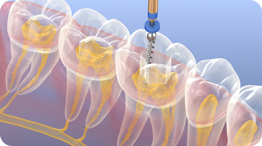 Traitements et retraitements endodontiques à Toulouse Dentiste à Toulouse, Dentiste Mathieu Benichou