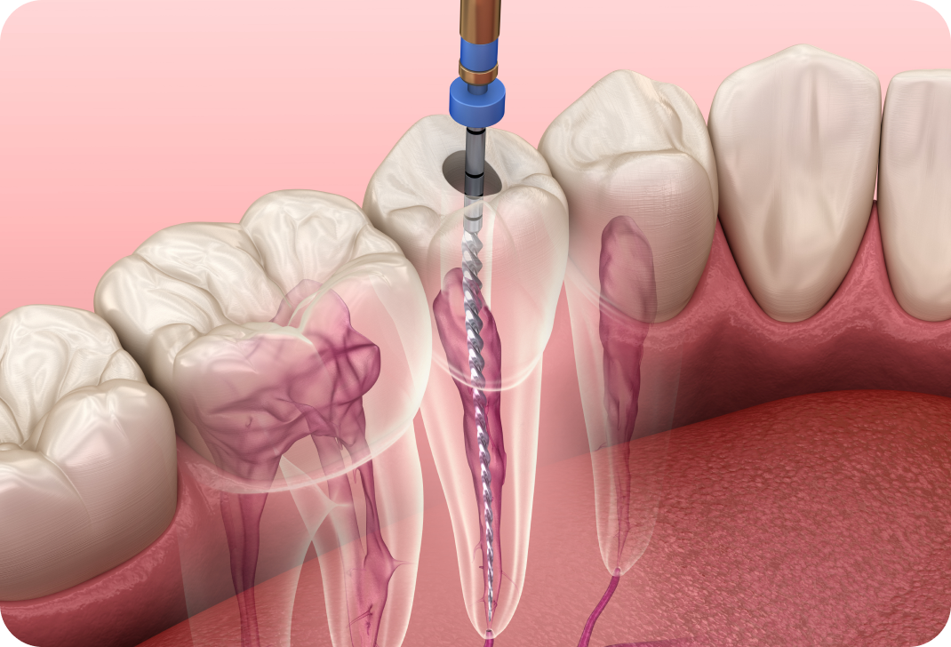 Traitements et retraitements endodontiques à Toulouse Dentiste à Toulouse, Dentiste Mathieu Benichou