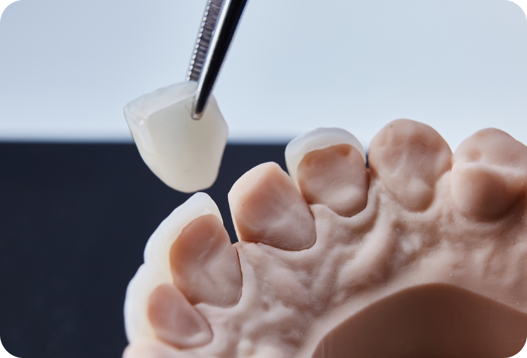 Facette dentaire Toulouse : retrouvez de belles dents et un beau sourire ! Dentiste à Toulouse, Dentiste Mathieu Benichou