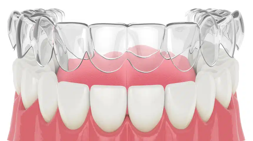 Gouttière dentaire : usages & types ! Dentiste à Toulouse, Dentiste Mathieu Benichou