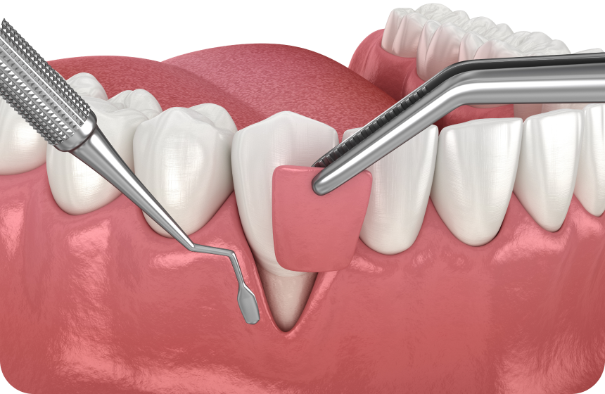 Greffe de gencive à Toulouse Dentiste à Toulouse, Dentiste Mathieu Benichou