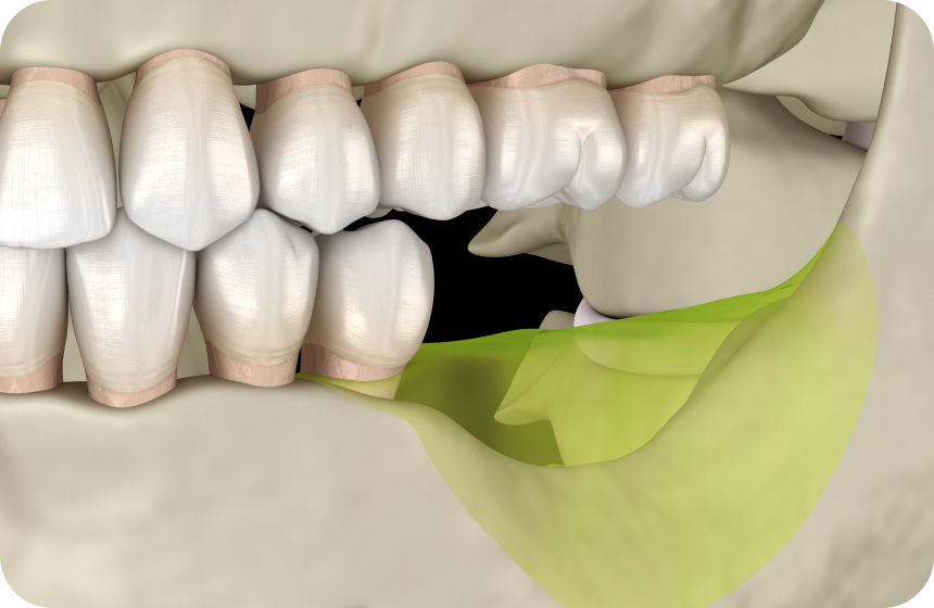 Régénération osseuse guidée : explication de dentiste Dentiste à Toulouse, Dentiste Mathieu Benichou