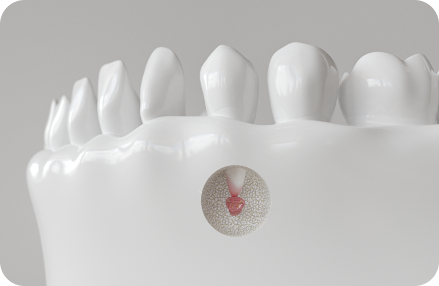 Les résections apicales en endodontie Dentiste à Toulouse, Dentiste Mathieu Benichou