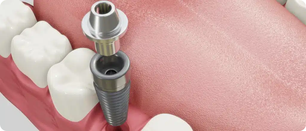 Implant dentaire à Toulouse Dentiste à Toulouse, Dentiste Mathieu Benichou