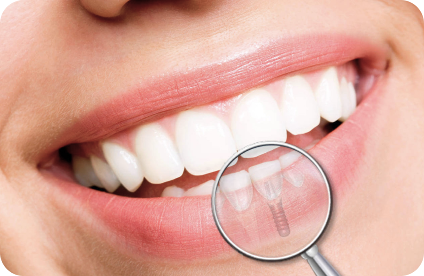 Quel est le temps de cicatrisation d’un implant dentaire ? Dentiste à Toulouse, Dentiste Mathieu Benichou