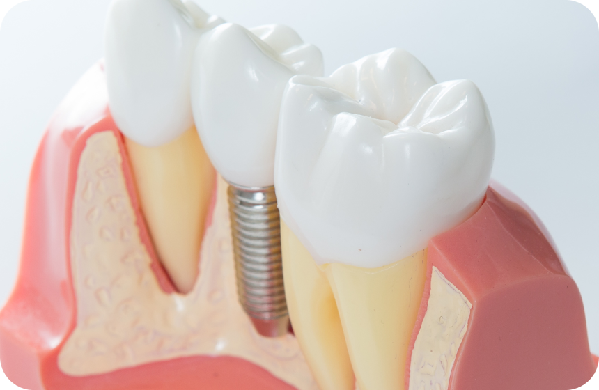 Quelle durée de vie pour un implant dentaire ? Dentiste à Toulouse, Dentiste Mathieu Benichou